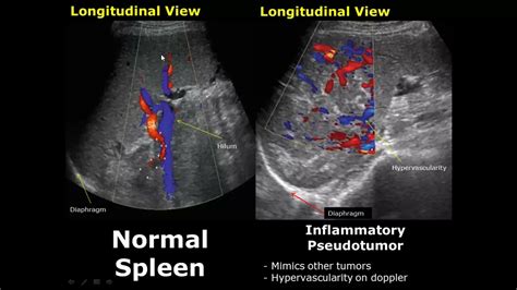 Normal Spleen Measurement Ultrasound