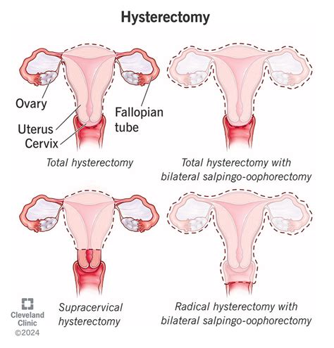 Hysterectomy - Lucila Zaragoza