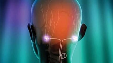 Occipital Nerve Stimulation Implant, a Community Crowdfunding Project ...