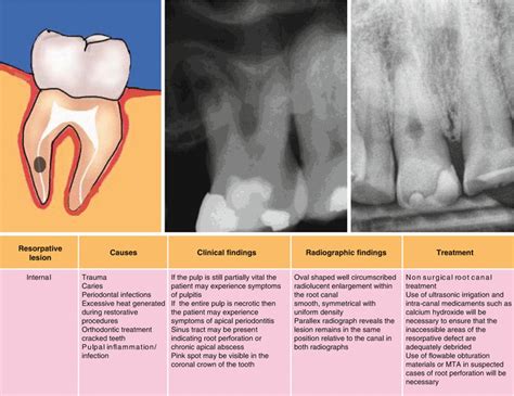 Root Resorption | Pocket Dentistry