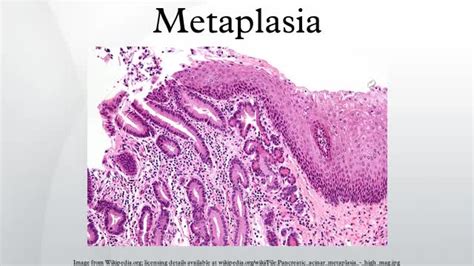 EXAMS AND ME : Metaplasia