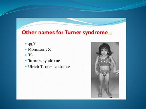 Turner syndrome - online presentation