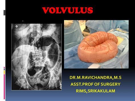 PPT - VOLVULUS PowerPoint Presentation, free download - ID:3343529