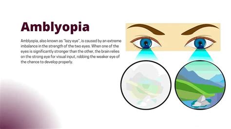 Everything you need to know about amblyopia