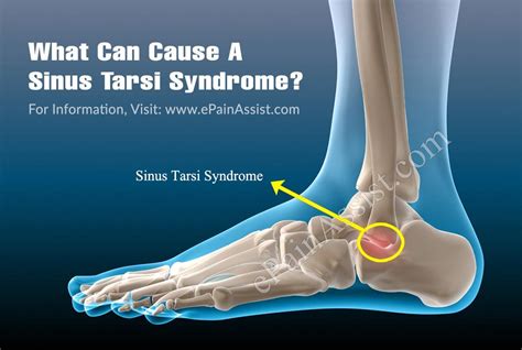 Sinus Tarsi Anatomy - Anatomical Charts & Posters