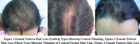 Top 48 image can anemia cause hair loss - Thptnganamst.edu.vn