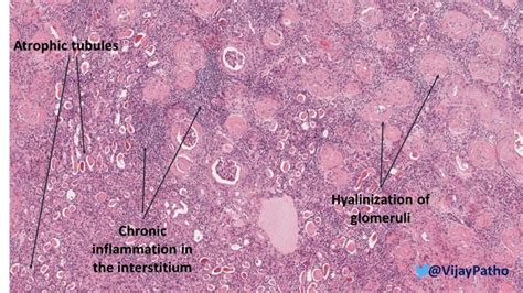 CHRONIC PYELONEPHRITIS - Pathology Made Simple