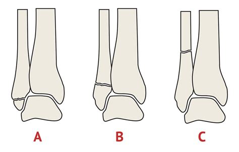 Weber Classification Fibula Fracture