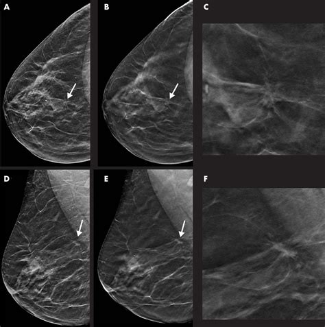 Tomosynthesis with synthetic mammography impr | EurekAlert!