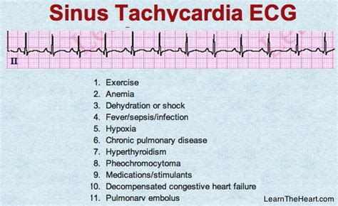 LearntheHeart.com on Twitter: "Sinus Tachycardia #ECG: Name 10 causes ...