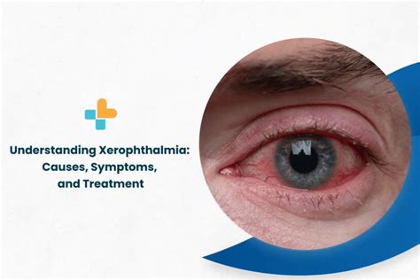 Understanding Xerophthalmia: Causes, Symptoms, And Treatment