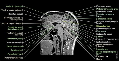 Brain MRI 3D: normal anatomy | e-Anatomy