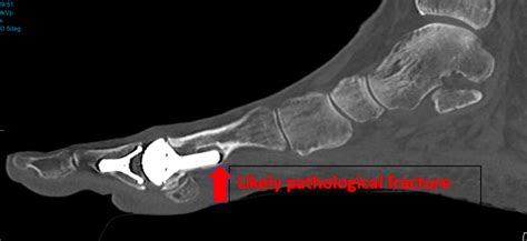 Case Discussion: First Metatarsophalangeal Joint Replacement Conversion to a Fusion