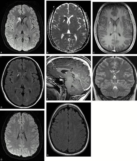 Acute and Chronic Brain Infarcts on MR Imaging in a 20-Year-Old Woman ...