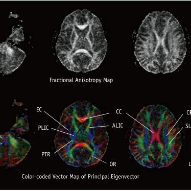 Calculation of fractional anisotropy. Largest vector of diffusion... | Download Scientific Diagram