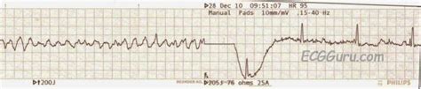 Defibrillation | ECG Guru - Instructor Resources