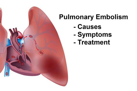 Pulmonary Embolism Blood Clot In Lung Symptoms Causes Diagnosis | My XXX Hot Girl