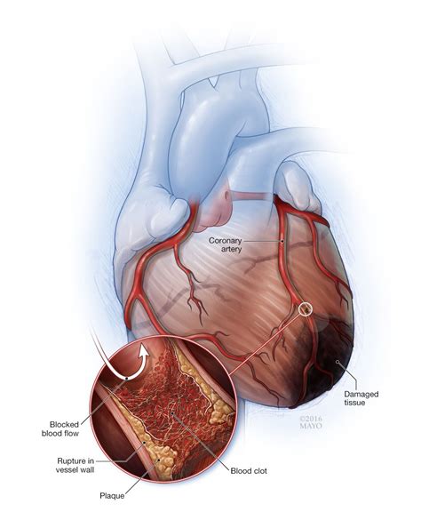 Cardiovascular Disease & Smoking | Guides & Tools | BecomeAnEX