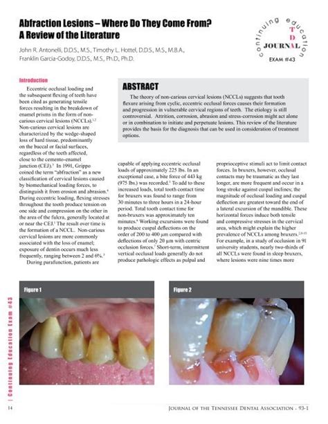 Tooth Abfraction Treatment