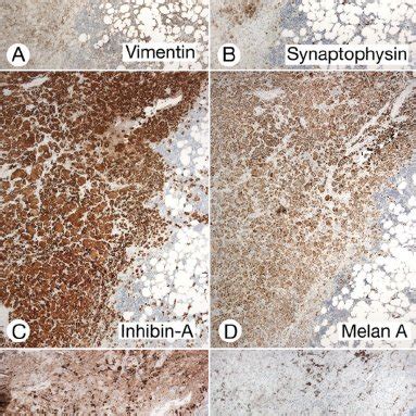 Hilar Cell Tumor. Immunostaining showed positivity of various numbers ...