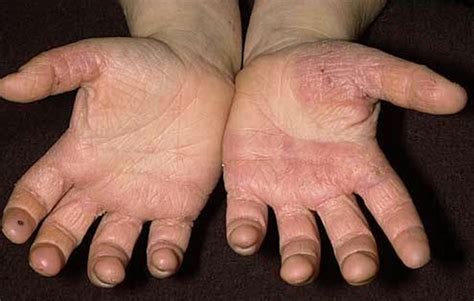 👉 Hand Fungus - Pictures, Symptoms, Treatment and Causes (February 2022)