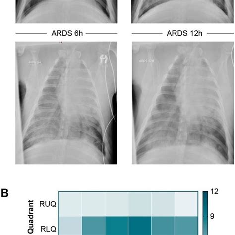 Radiographic progression of ARDS. (A) Representative chest x-rays from ...