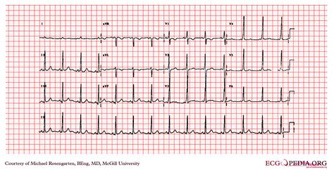 Wolff-Parkinson-White syndrome EKG examples - wikidoc