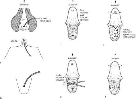 Figure 1 from The endorectal advancement flap procedure | Semantic Scholar