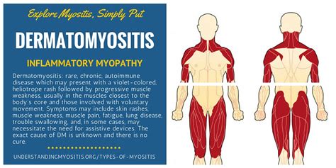 Dermatomyositis is a rare autoimmune disease - Myositis Support and ...