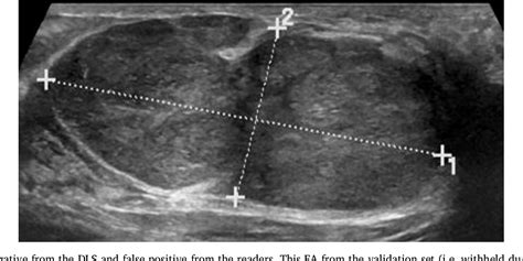 Distinction between phyllodes tumor and fibroadenoma in breast ultrasound using deep learning ...