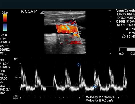 Carotid Duplex on Patient with Aortic Regurgitation