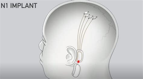 The Revolutionary Breakthrough of Neuralink: A New Era of Brain ...