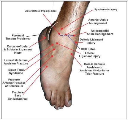 Persistent pain after lateral ankle sprain: A Diagnostic and treatment Dilemma A Review Article