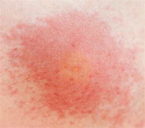 Pictures of Skin Rashes | LoveToKnow Health & Wellness | Bug bites ...