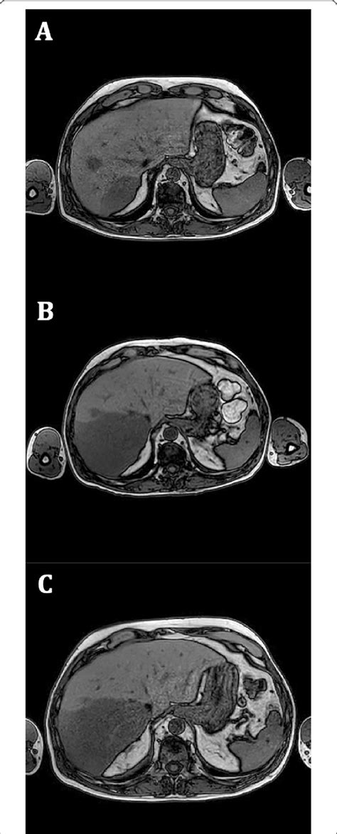 A Initial MRI showing liver spread of the disease (March 2018). Hepatic... | Download Scientific ...