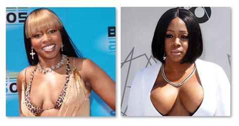 Remy Ma Before And After Plastic Surgery Plastic Surgery Pictures, Neck Liposuction, Facial ...