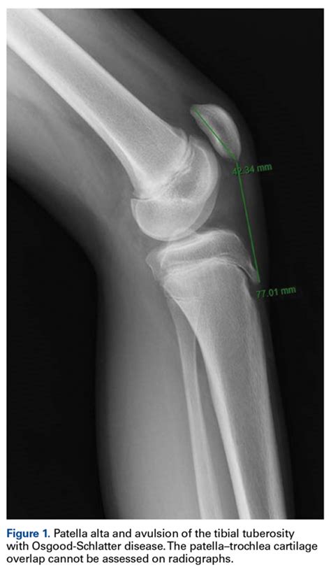 Patella Alta: A Comprehensive Review of Current Knowledge | MDedge Surgery