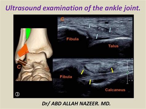 Presentation1.pptx. ultrasound examination of the ankle joint.