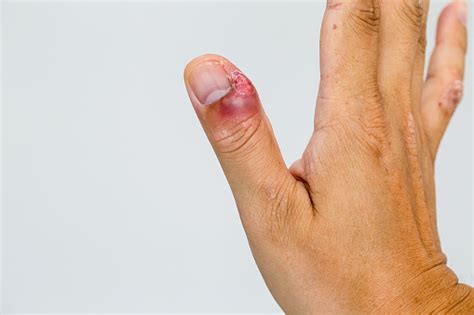 Paronychia Swollen Finger With Fingernail Bed Inflammation Due To ...