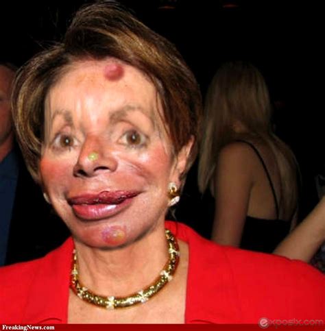 More Plastic Surgery Gone Wrong Nancy Pelosi With Botox Gone Wrong | Plastic surgery gone wrong ...