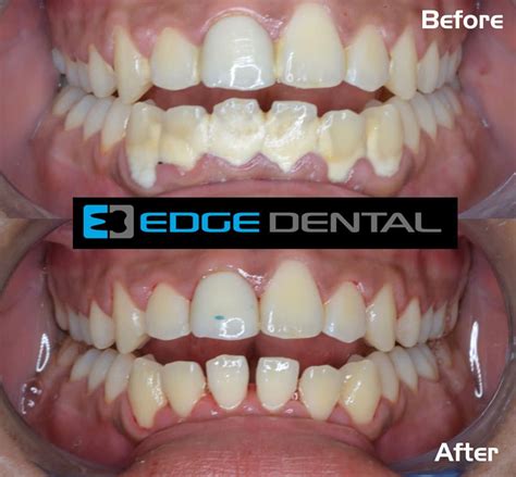 Dental Deep Cleaning Houston | Deep Cleaning Procedure | Edge Dental