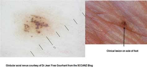 Dermoscopy Made Simple: Acral nevus