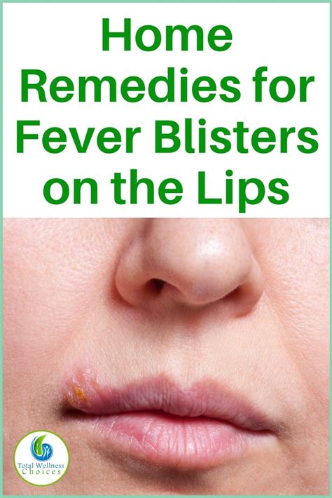 13 Natural Home Remedies for Fever Blisters on the Lips | Home remedies ...