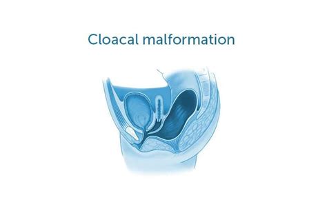 SALUD Y MEDICINA: Abordaje laparoscópico de malformaciones anorrectales