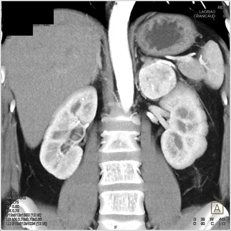 Pheochromocytoma Left Adrenal Gland - Adrenal Case Studies - CTisus CT ...