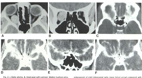 Figure 1 from High-resolution CT of lesions of the optic nerve ...