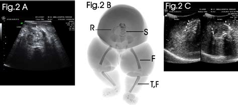 Figure 1 from Twin reversed arterial perfusion sequence: acardiac ...