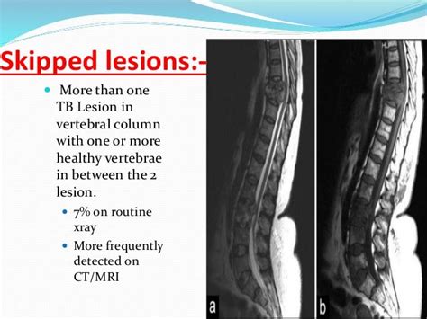 Tuberculosis Of Spine