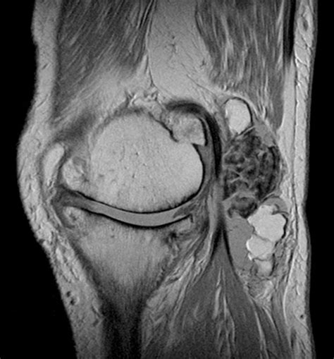 Synovial osteochondromatosis inside a Baker's cyst | Eurorad