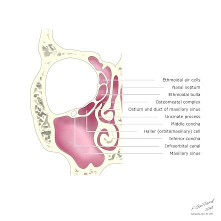 Haller cells | Radiology Reference Article | Radiopaedia.org